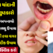 mouth ulcer home remedies